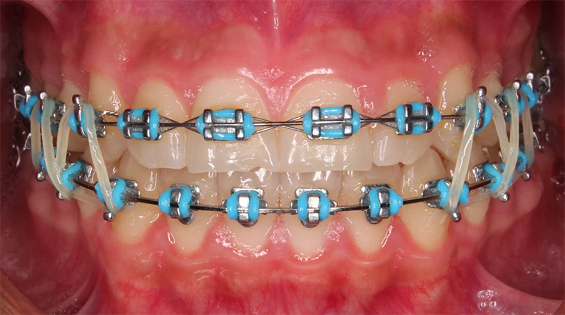 caso brackets