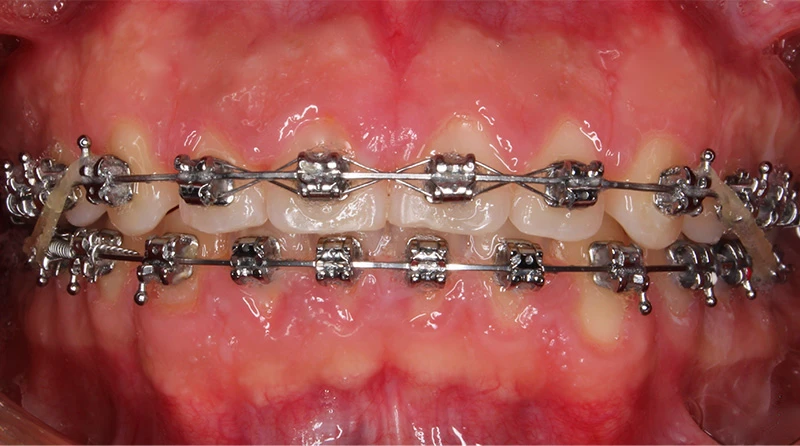 caso brackets
